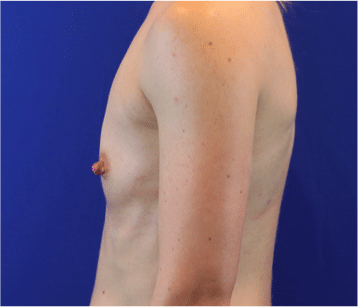Before Image: Patient Case #3818 - left-side