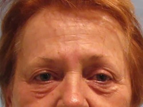 Before Image: Patient Case #3514 - front
