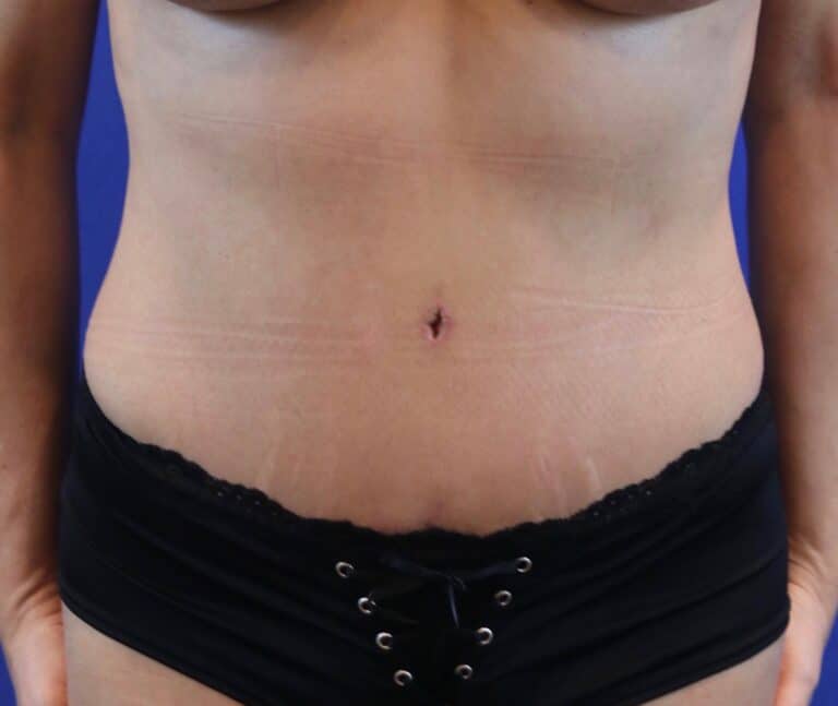 After Image: Patient Case #3996 - front