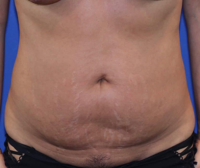 Before Image: Patient Case #3996 - front