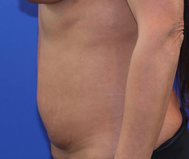 Before Image: Patient Case #3996 - left-side