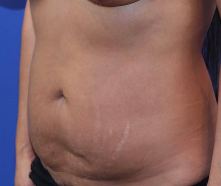 Before Image: Patient Case #3996 - left-front-oblique