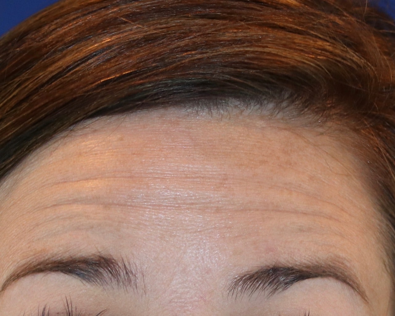 woman’s wrinkled forehead before botox injections