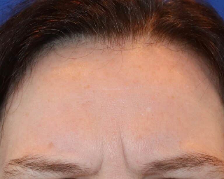 Before Image: Case #490 - front