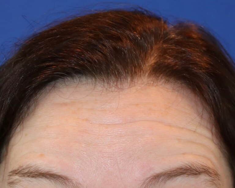 Before Image: Case #490 - front