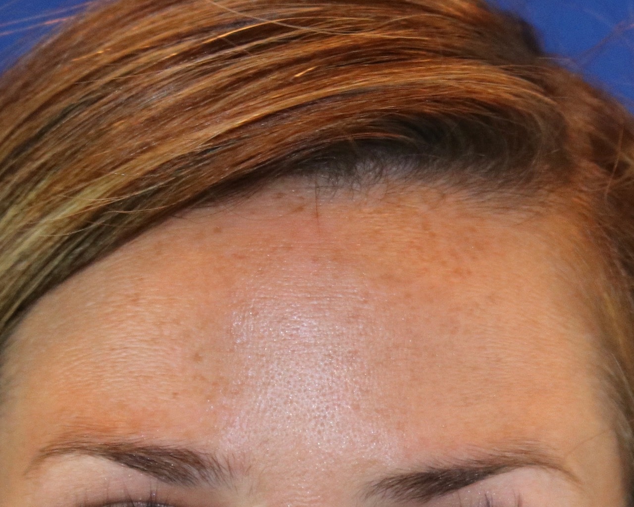 woman’s forehead, no wrinkles after botox treatment