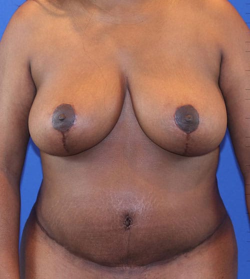 After Image: Patient Case #3004 - front