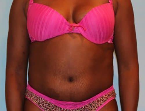 After Image: Patient Case #3569 - front