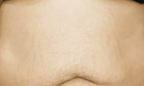 After Microneedling Dallas TX