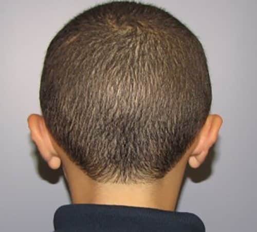 After Image: Patient Case #1201 - back