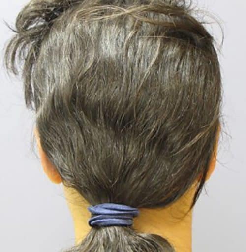 After Image: Patient Case #2994 - front