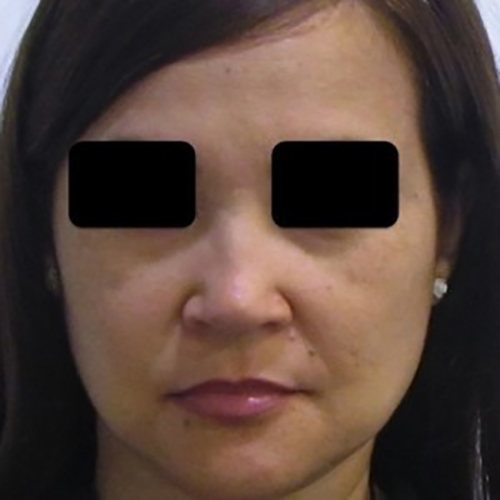 After Image: Case #0589 - front