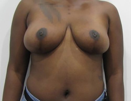 After Image: Patient Case #3009 - front