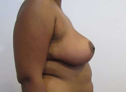 After Image: Patient Case #4852 - right-side