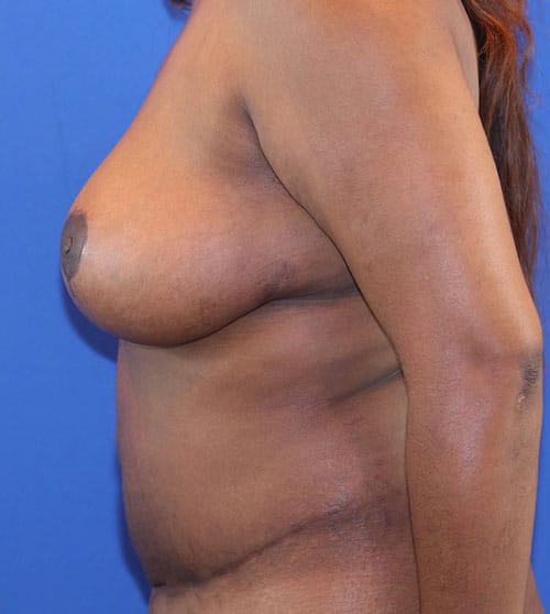 After Image: Patient Case #3004 - left-side