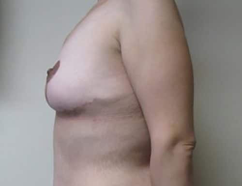 After Image: Patient Case #3050 - left-side