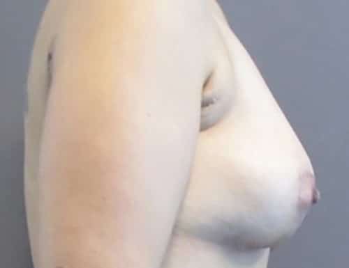 After Image: Patient Case #1052 - right-side