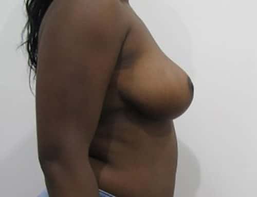 After Image: Patient Case #3009 - right-side