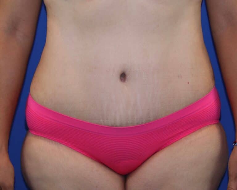 After Image: Patient Case #3873 - front