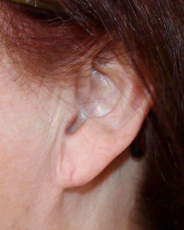 After Image: Patient 1 - other