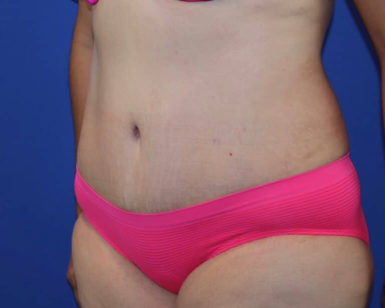 After Image: Patient Case #3873 - left-front-oblique