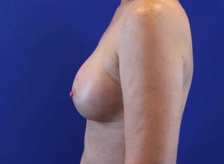 After Image: Patient Case #2995 - left-side