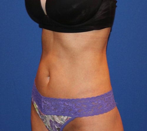 After Image: Patient Case #3201 - left-front-oblique