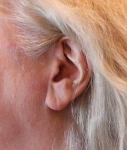 After Image: Patient 2
