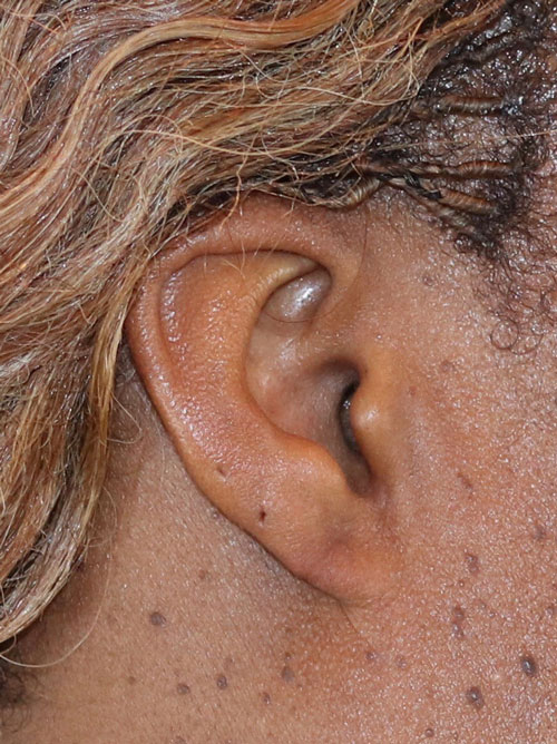 After Image: Patient 4 - front