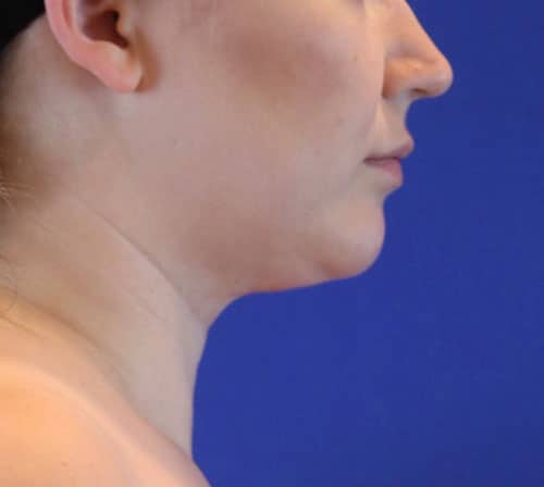 After Image: Patient Case #3202 - right-side