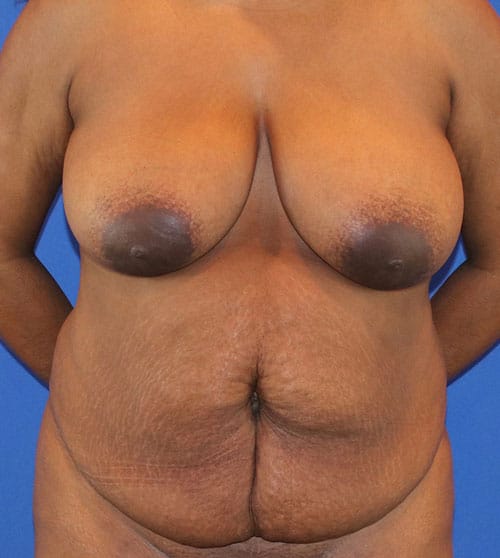 Before Image: Patient Case #3004 - front