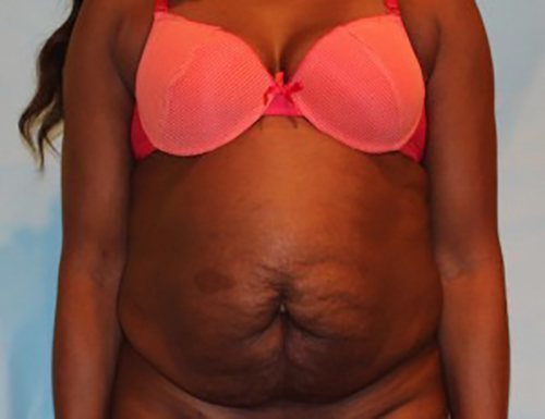 Before Image: Patient Case #3569 - front