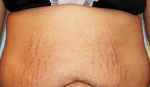 before Microneedling Plano TX
