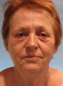Before Image: Patient Case #3515