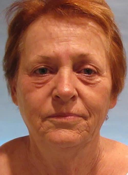 Before Image: Patient Case #3515 - front