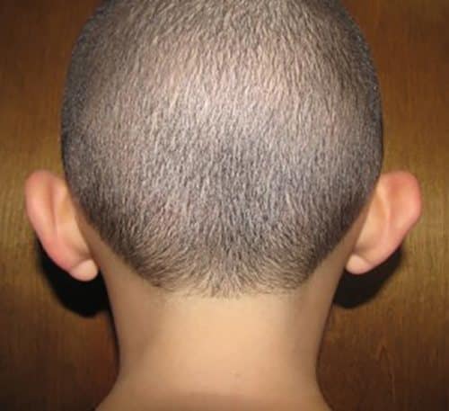 Before Image: Patient Case #1201 - back