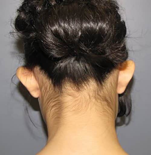 Before Image: Patient Case #2994 - front