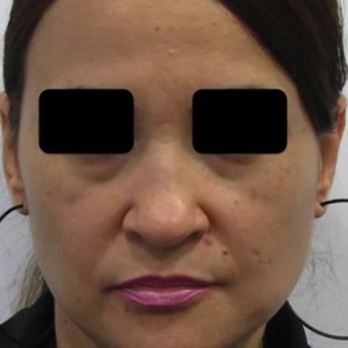 Before Image: Case #0589 - front