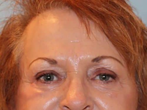 After Image: Patient Case #3514 - front