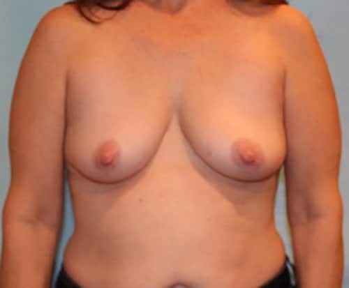 Before Image: Patient Case #5751 - front