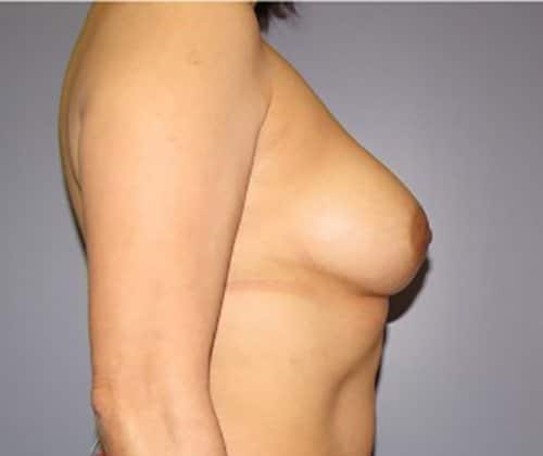 Before Image: Patient Case #4855 - right-side