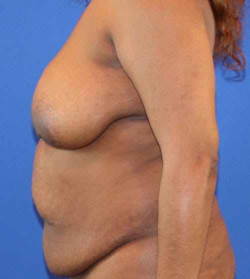 Before Image: Patient Case #3004 - left-side