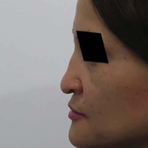 Before Image: Case #0589 - left-side