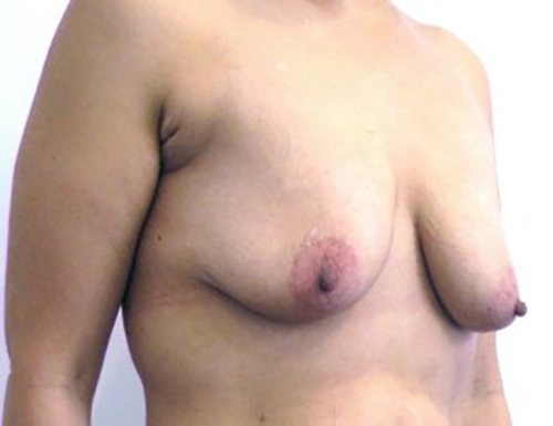 Before Image: Patient Case #1052 - right-front-oblique