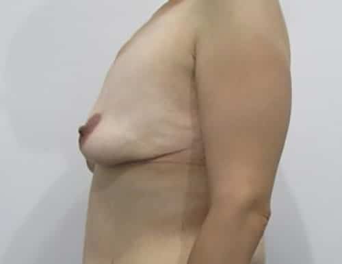 Before Image: Patient Case #3050 - left-side