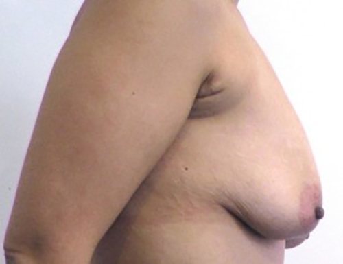 Before Image: Patient Case #1052 - right-side