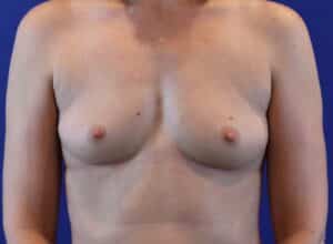 Before Image: Patient Case #2995