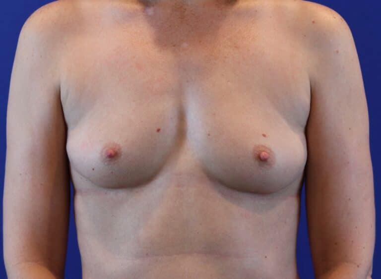 Before Image: Patient Case #2995 - front