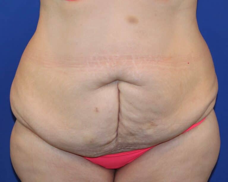 Before Image: Patient Case #3873 - front