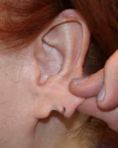 Before Image: Patient 1